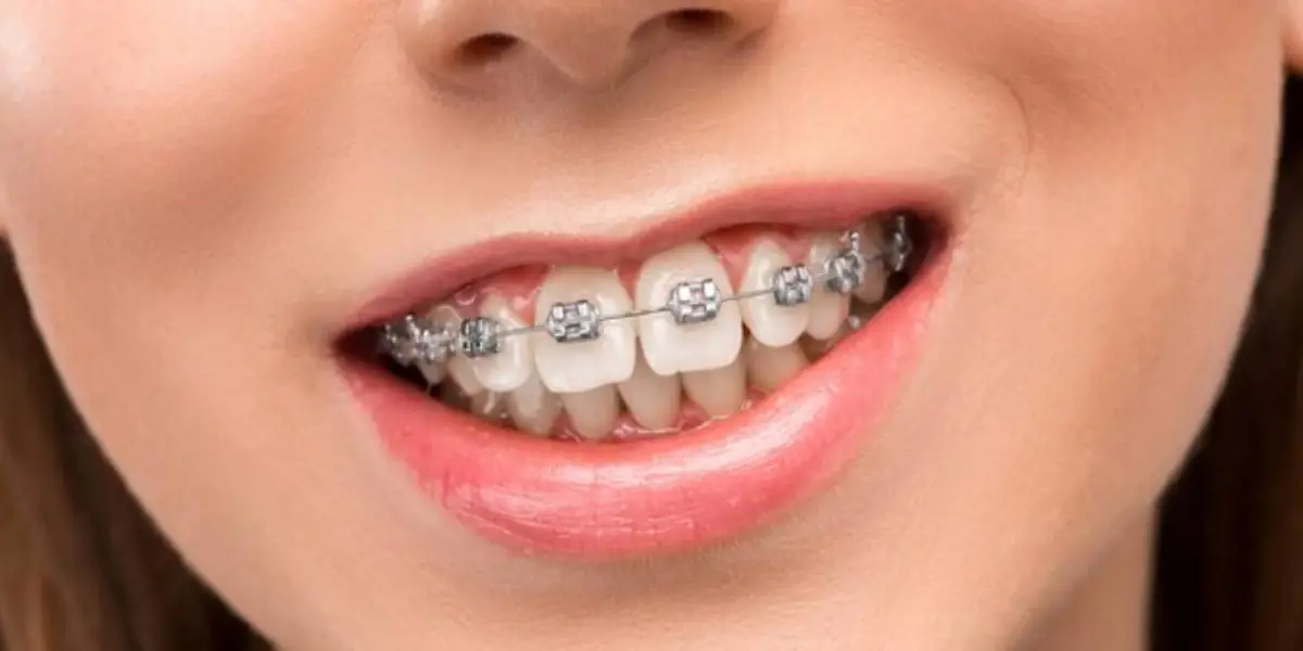 Teeth aligners cost