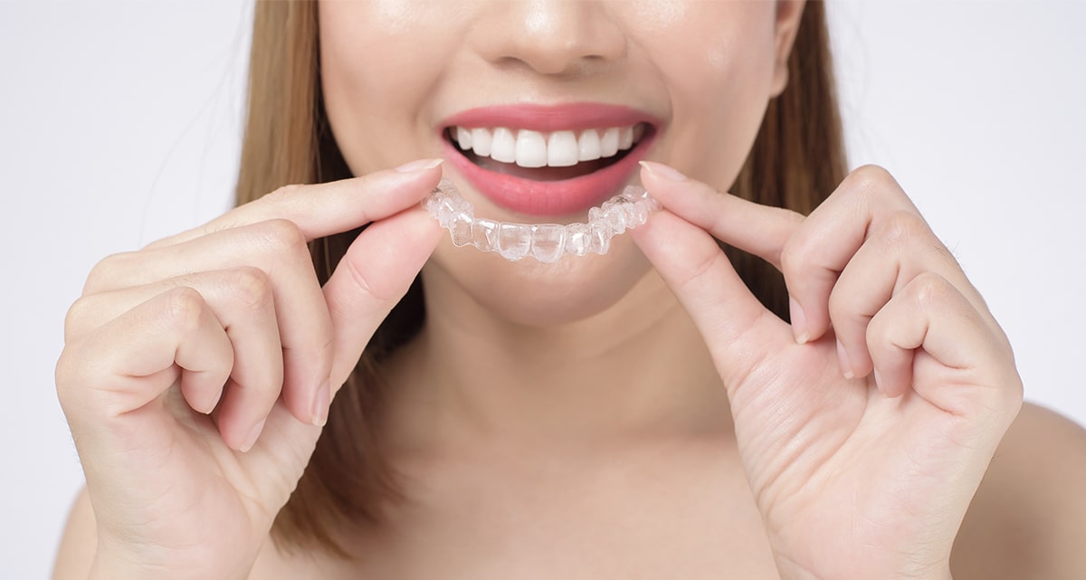 Difference between Aligners vs braces - Illusion Aligners