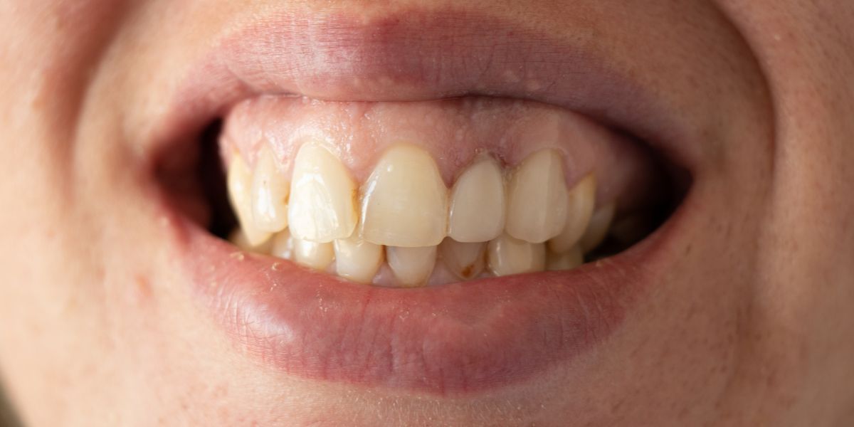 Classification of Malocclusion and its Types - Illusion Aligners