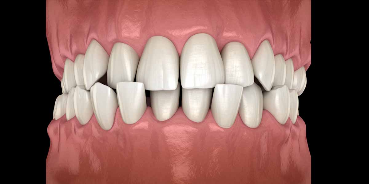 Understanding Diastema - Gaps between Teeth