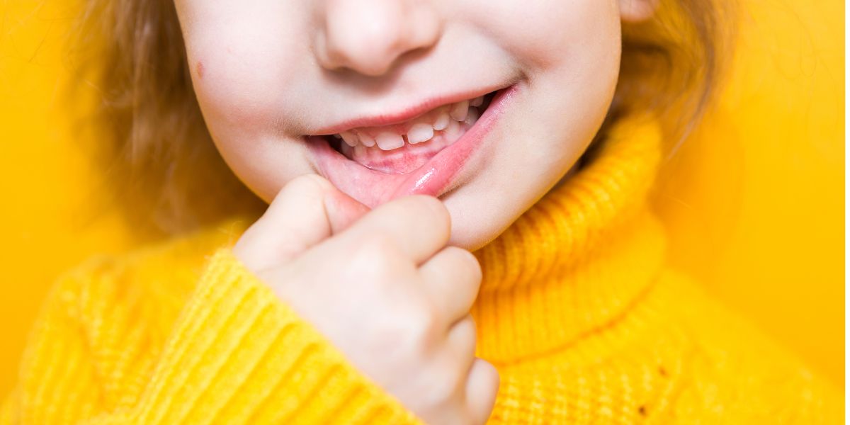 Malocclusion in Children: Causes, Signs and Treatment - Illusion Aligners