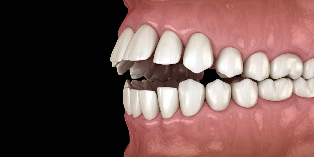 malocclusion teeth 