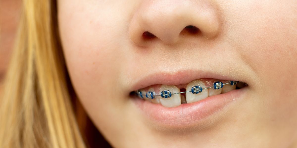 Teeth Gap Fillings - How to fill teeth gaps - Illusion Aligners