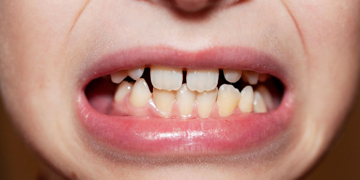  teeth alignment
