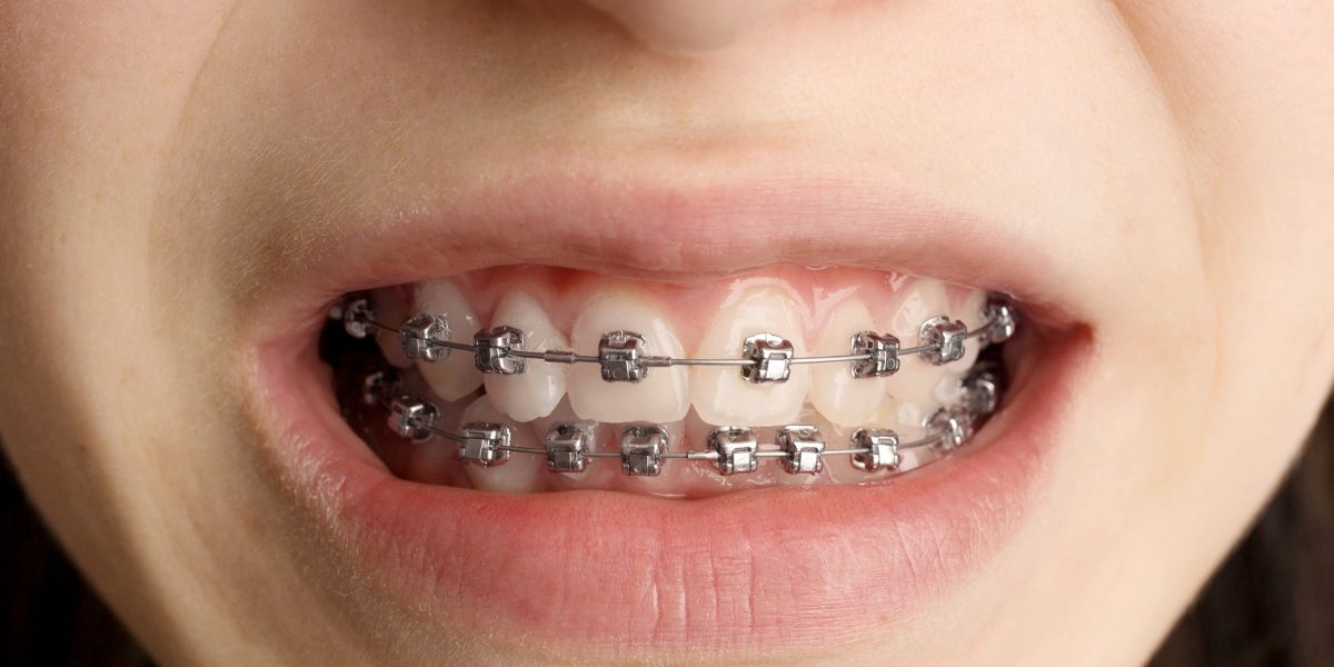 Understanding Malocclusion - A Detailed Guide to Understanding, Treatment, and Preventing Teeth Misalignment - Illusion Aligners