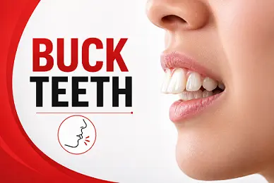buck teeth