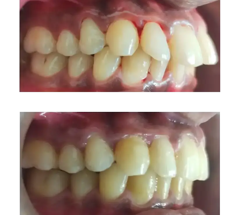 Clear Aligners Before And After See Real Smile Results