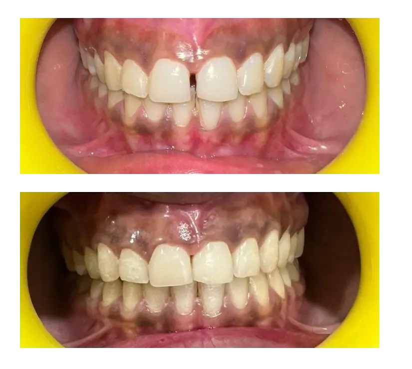 Is Crooked Teeth Attractive