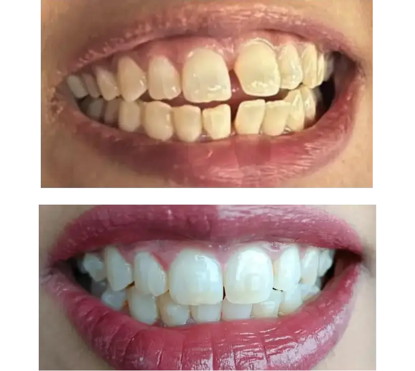 Is Crooked Teeth Attractive
