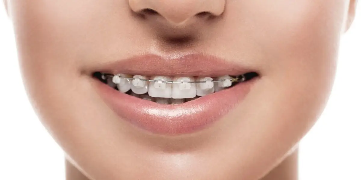 Teeth Gap Fillings - How to fill teeth gaps - Illusion Aligners