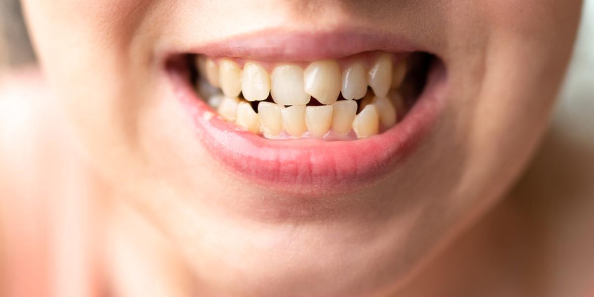 Top Causes of Malocclusion In Children Explained 