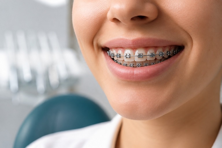 damon braces blog thumbnail