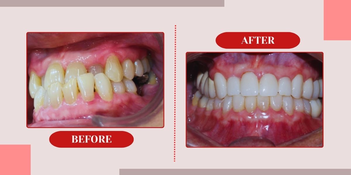 clear aligners before and after results 