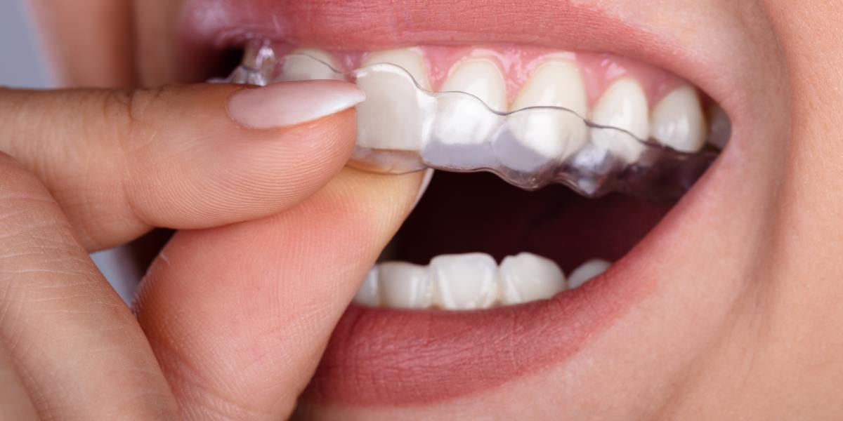 Invisible aligners cost