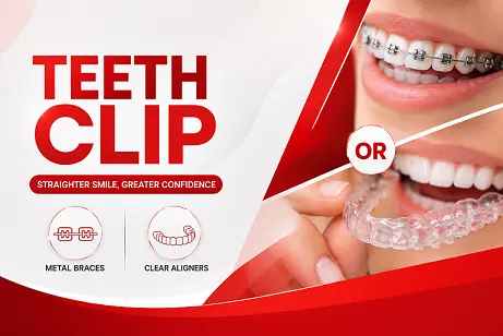 dental clips for teeth