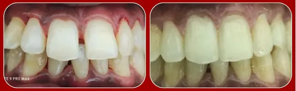 teeth clip before and after