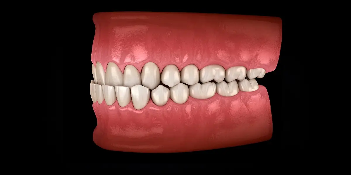 Understanding Diastema - Gaps between Teeth