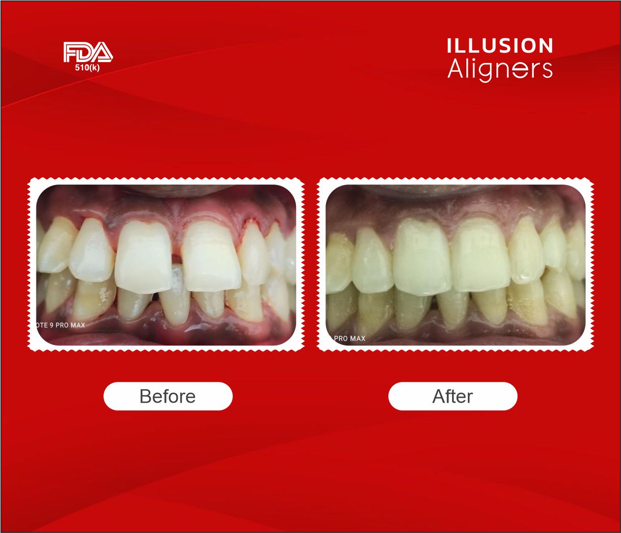 filling midline diastema with illusion aligners