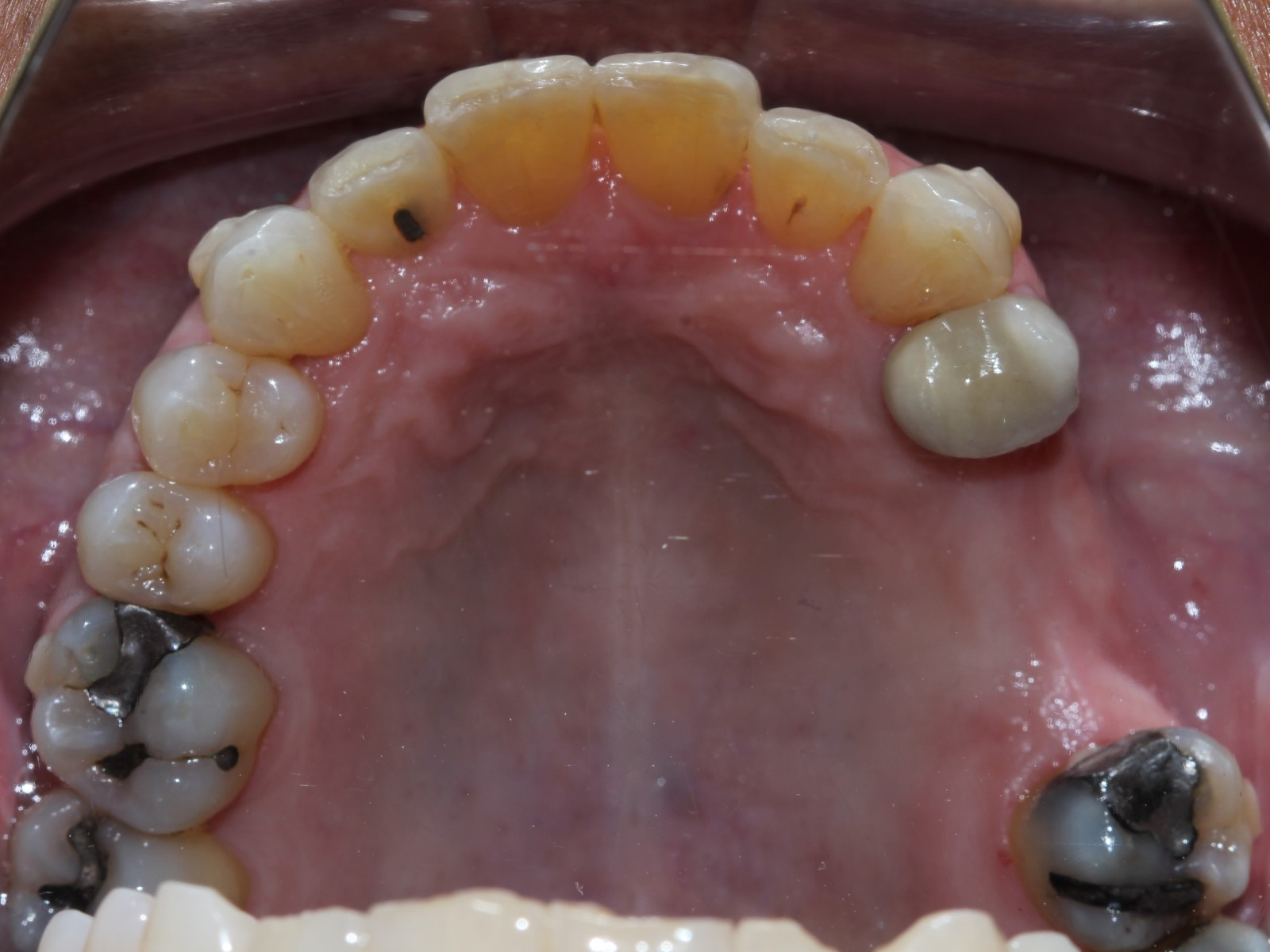 Frontal View After