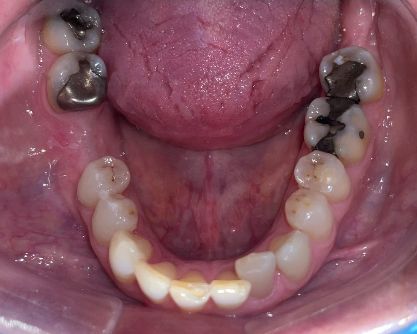 Upper Occlusal View Before