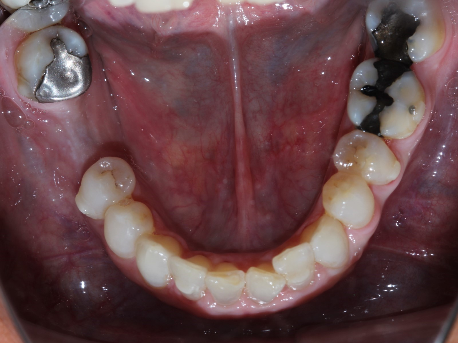 Upper Occlusal View After