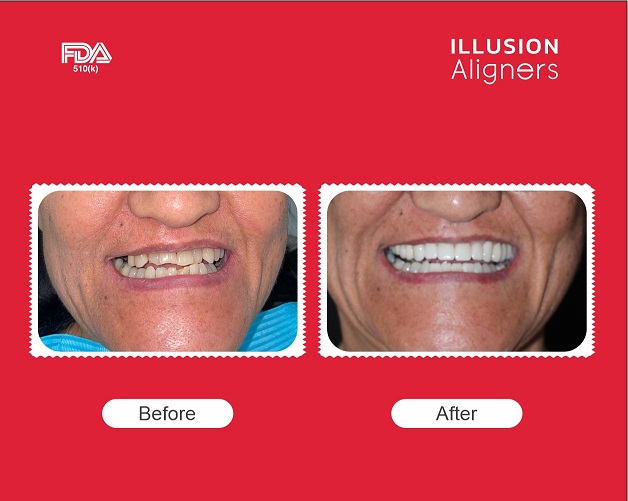 case study aligners