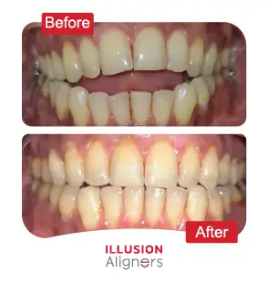 Illusion Aligners