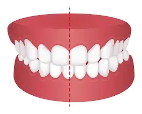 Crossbite