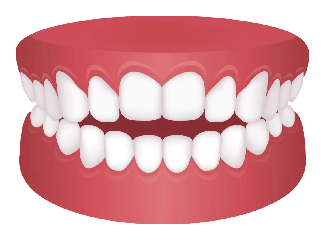 Open Bite